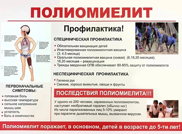 Полиомиелит – это острое инфекционное заболевание, поражающее нервную систему (преимущественно спинной мозг), что приводит к параличам, а также воспалительным изменениям слизистой оболочки кишечника и носоглотки..
